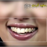 فیلم آموزش سفید کردن دندان در فتوشاپ